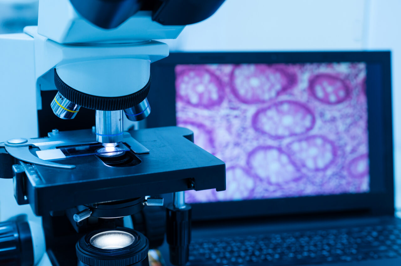Close-up of a compound microscope with objective lenses and stage in a blue-lit lab setting - symbolizing the misdiagnosis of cancer.